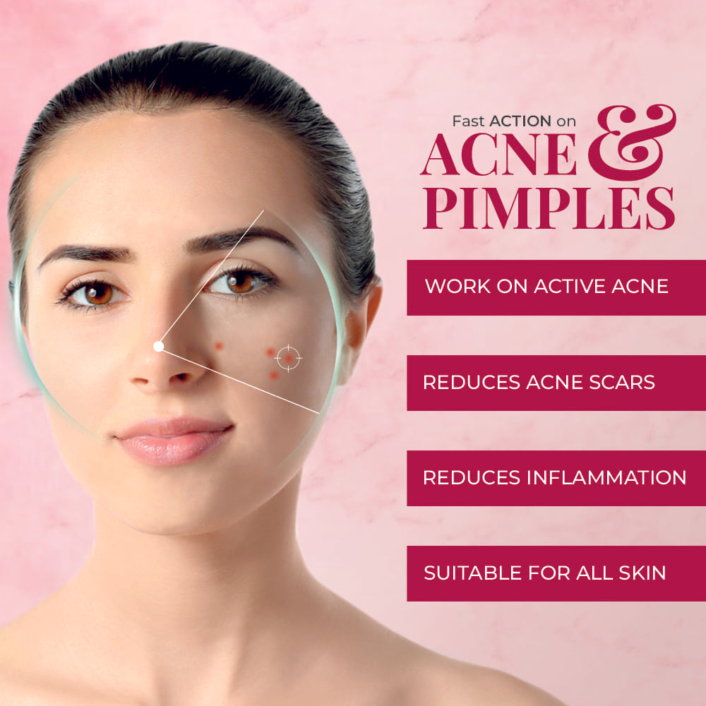 Acne-Free Skin During Humid Summer