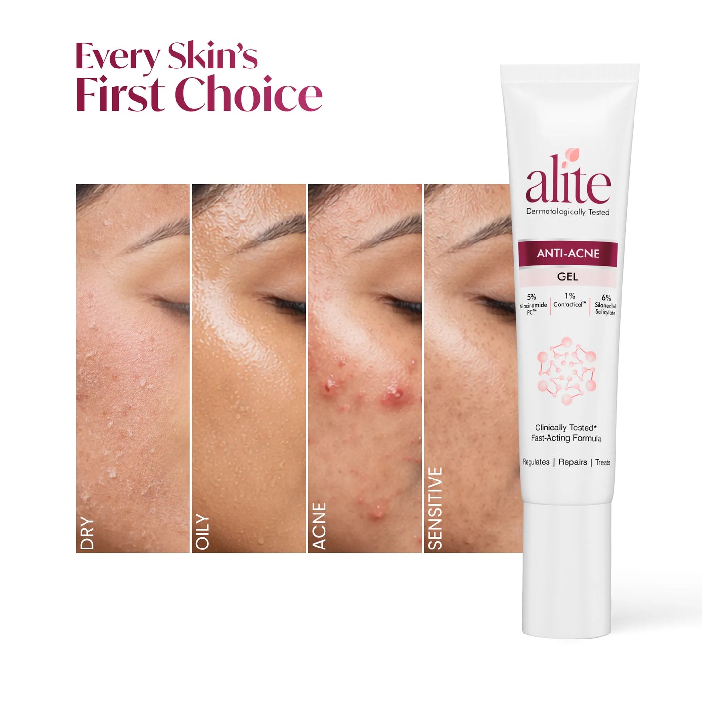 Alite Anti Acne Gel 30 gm | Fast Action on Acne, Pimples | Treats, Repairs, Prevents Acne