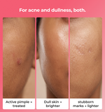 Before and after skin treatment showing active pimple dull skin