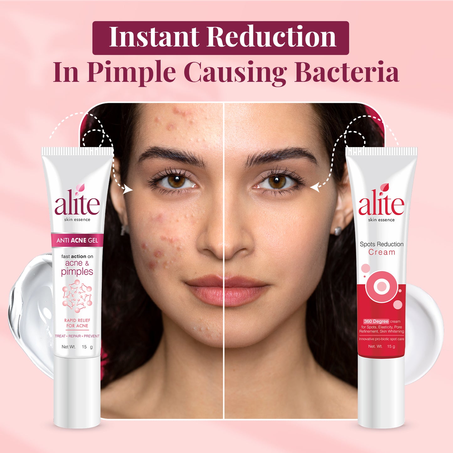 Alite Acne Control Combo - Anti Acne Gel & Dark Spot Reduction Cream