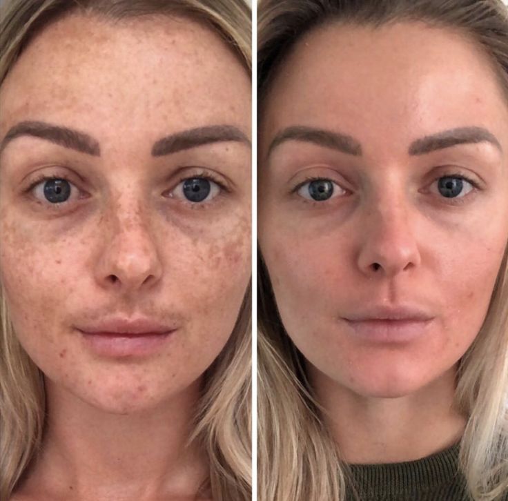 Friends Collection of Joy: Acne Gone, Confidence On