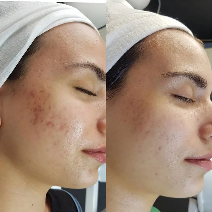 Alite Acne Control Combo - Anti Acne Gel & Dark Spot Reduction Cream