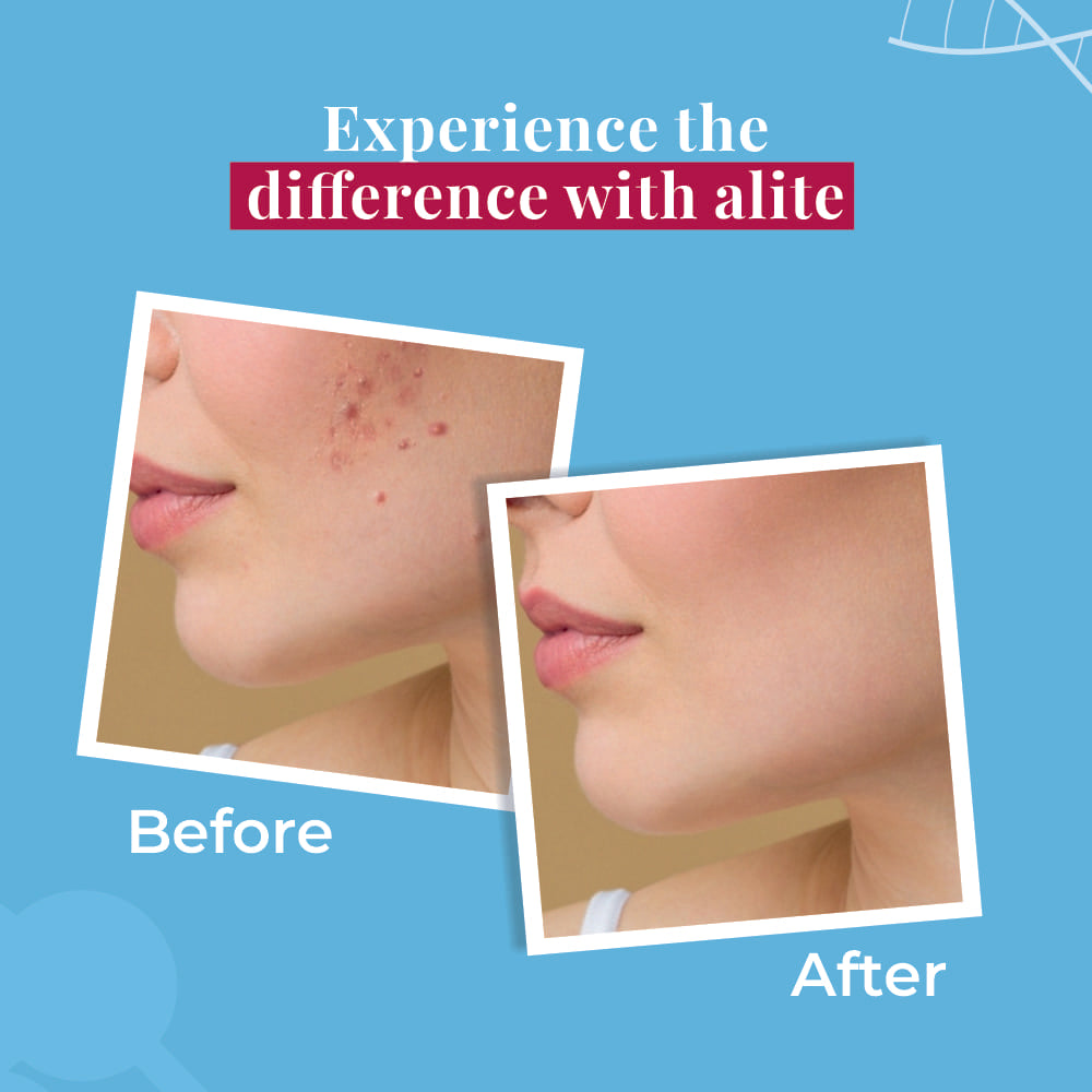 Spots Reduction Cream - Alite Skincare Experience Difference with alite