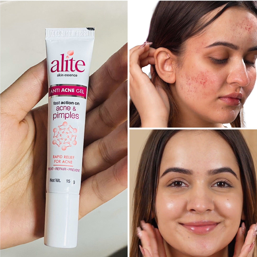 Alite Acne Control Combo - Anti Acne Gel & Dark Spot Reduction Cream