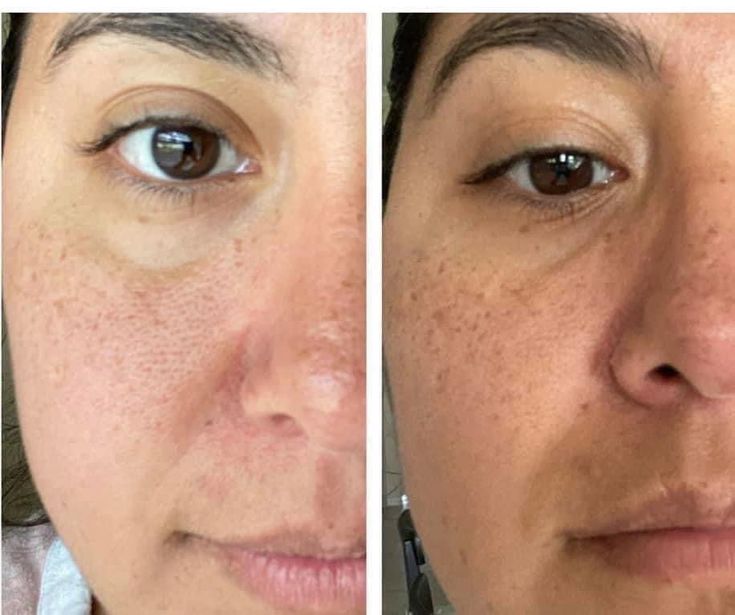 Alite Acne Control Combo - Anti Acne Gel & Dark Spot Reduction Cream