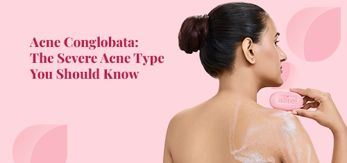acne conglobat the severe acne type you should know