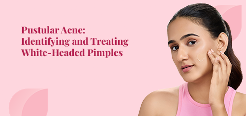 Pustular Acne: Identifying and Treating White-Headed Pimples