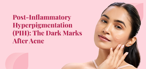 Post-Inflammatory Hyperpigmentation (PIH): The Dark Marks After Acne
