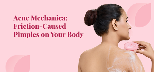 Acne Mechanica: Friction-Caused Pimples on Your Body