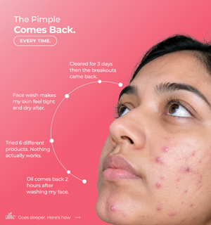 Person with acne  