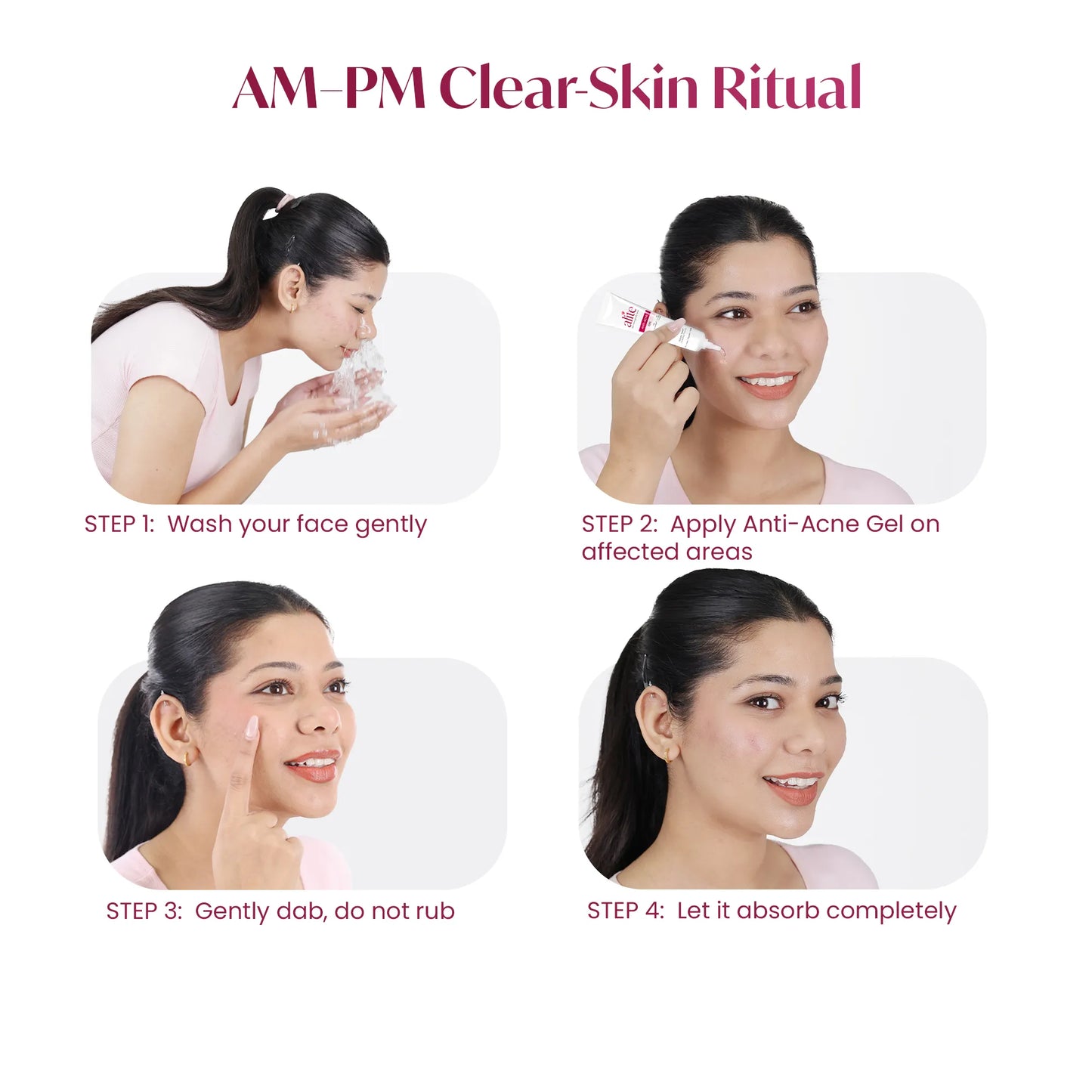 Alite Anti Acne Gel 30 gm | Fast Action on Acne, Pimples | Treats, Repairs, Prevents Acne