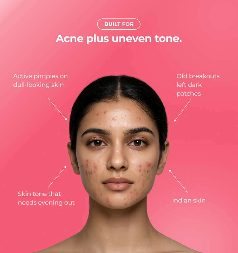 Woman with acne and uneven skin tone  