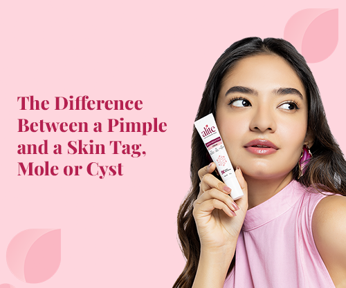 The Difference Between a Pimple and a Skin Tag, Mole or Cyst