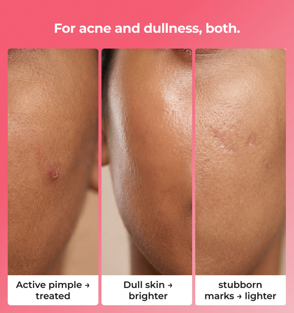Before and after skin treatment showing active pimple dull skin