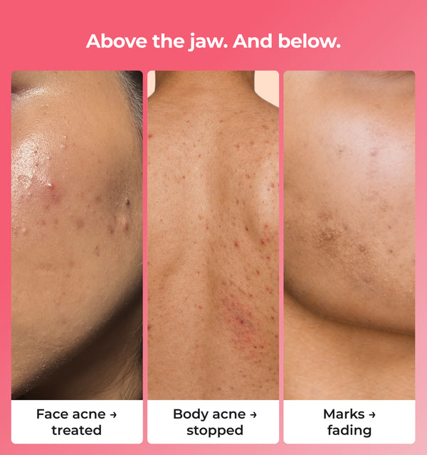 Before and after comparison of face and body acne treatment 