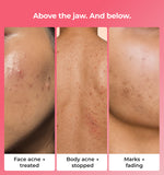 Before and after comparison of face and body acne treatment 