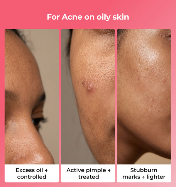 Before and after effects of skincare treatment on oily skin 