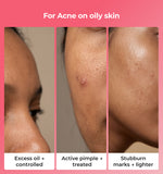 Before and after effects of skincare treatment on oily skin 