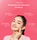 Anti-Acne Gel – Treats Acne, Pimples & Prevents Future Breakouts