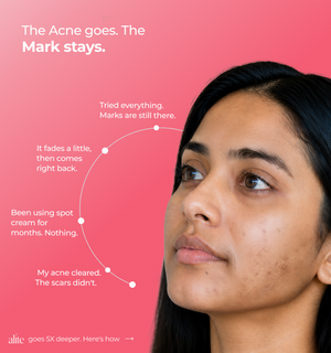 Womans face with acne scars with text about acne and marks