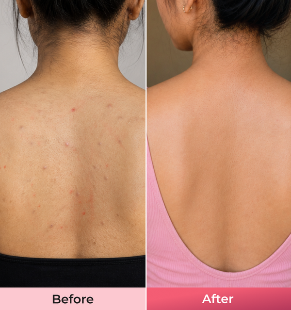 Before and after comparison of a person s back with visible skin improvement