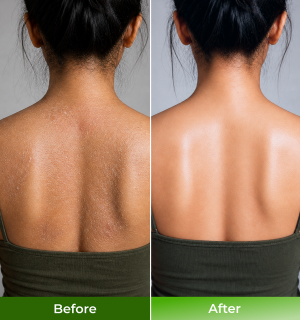 Before and after comparison of a persons back with visible scarring