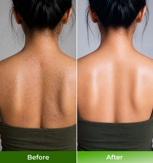Before and after comparison of a persons back with visible scarring
