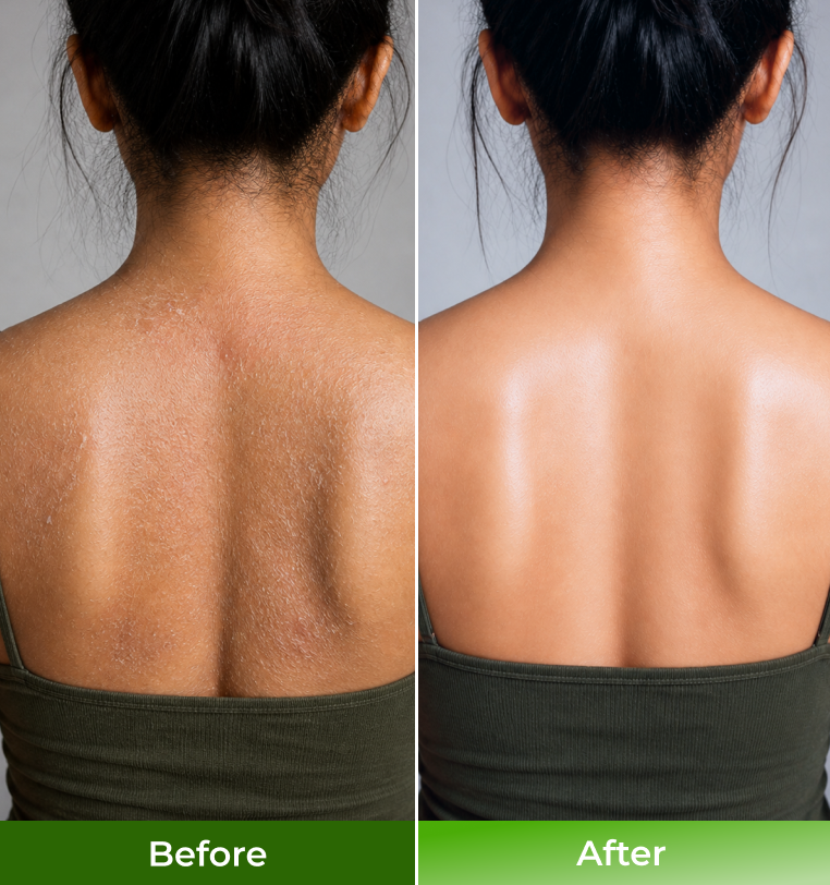 Before and after comparison of a persons back with visible scarring