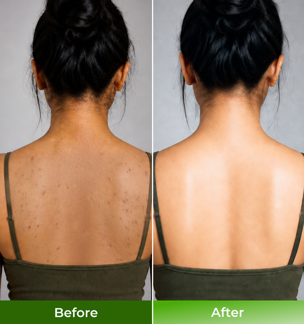 Before and after back acne comparison
