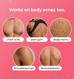 Advertisement for a skincare product targeting various body acne 