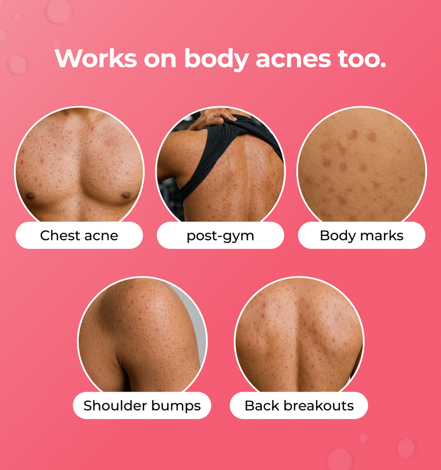 Advertisement for a skincare product targeting various body acne 