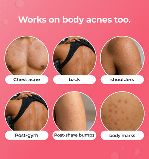 Illustration of different body acne types 