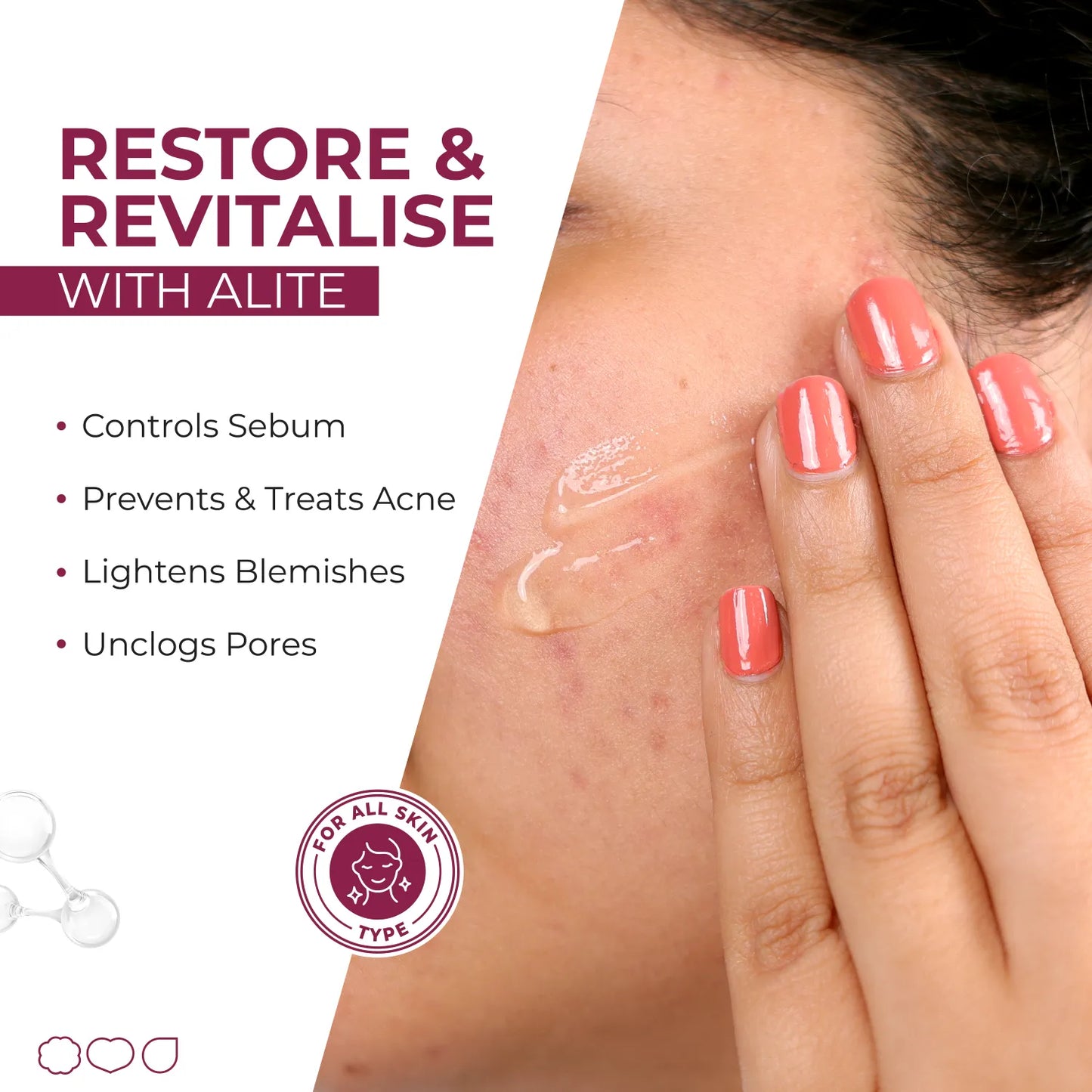 Alite Anti Acne Gel 30 gm | Fast Action on Acne, Pimples | Treats, Repairs, Prevents Acne