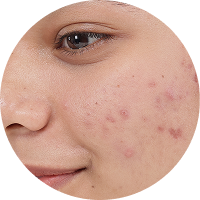 Acne & Breakouts