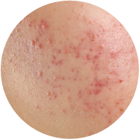 Acne & Breakouts