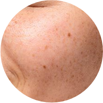 Clogged Pores & Blackheads