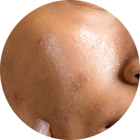 Oily Skin
