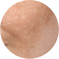 Pigmentation & Dark Spots